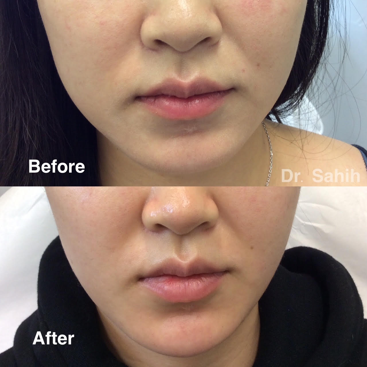 Facial Slimming Masseter Botox Richmond