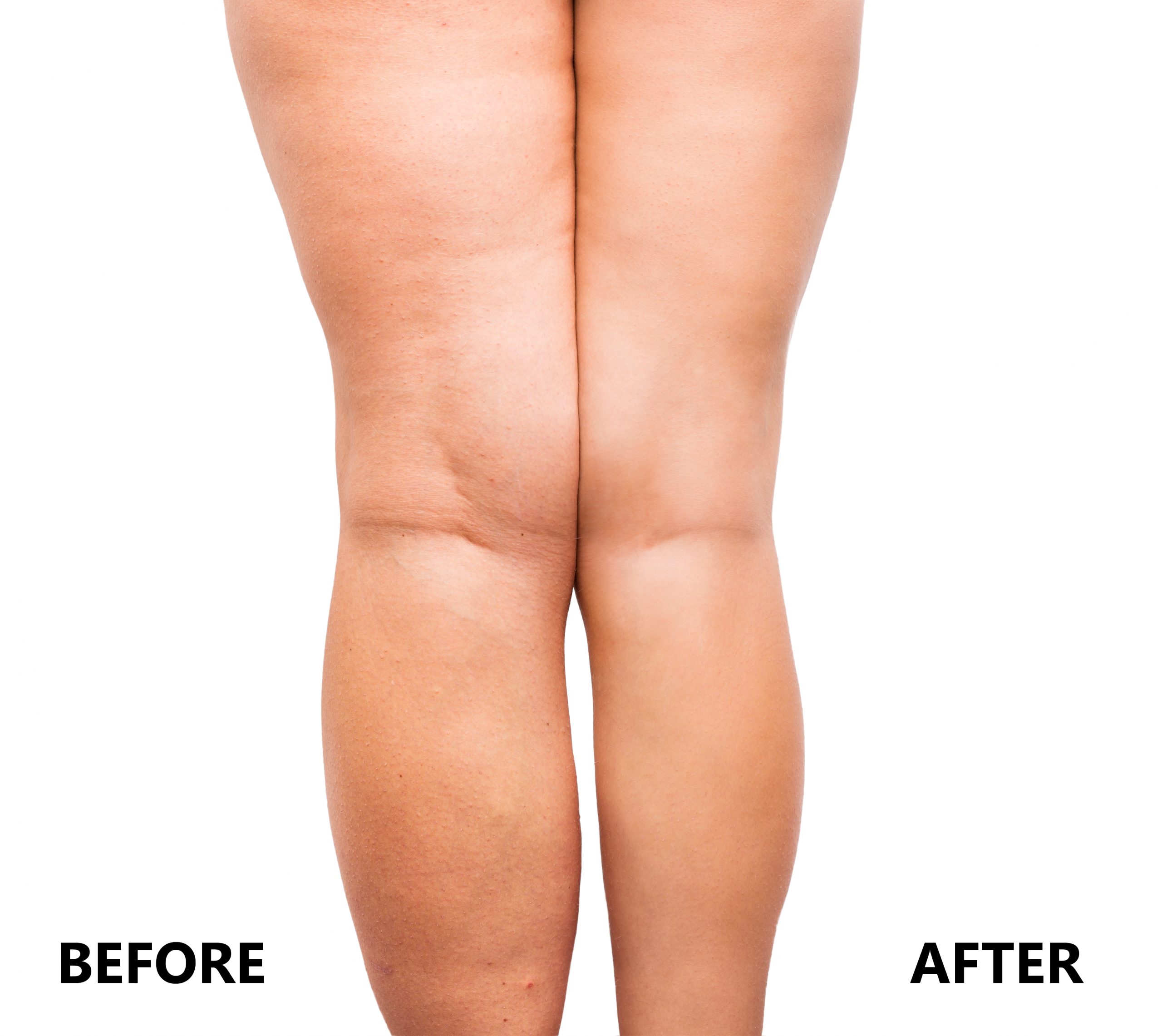 Non Surgical Calf Reduction